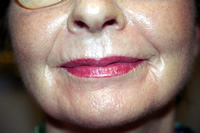 Post Lip