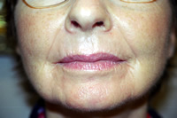 Pre Lip