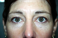 Post Upper/Lower Liner