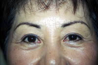 Post brow/line