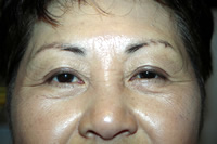 Pre Brow/Line