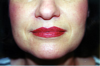Post Lip