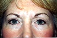 Post Brow/Liner