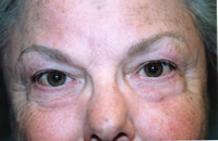 Post Brow